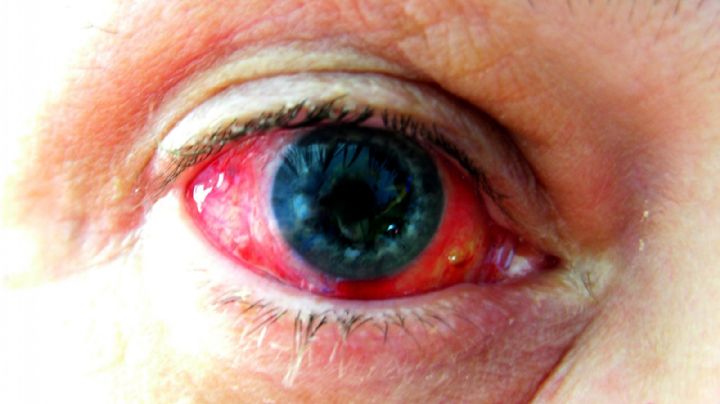 Aseguran que pacientes con Covid 19 sufren serios daños en los ojos