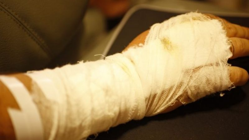 Doloroso: joven de 23 años se arrancó un dedo trabajando en una finca