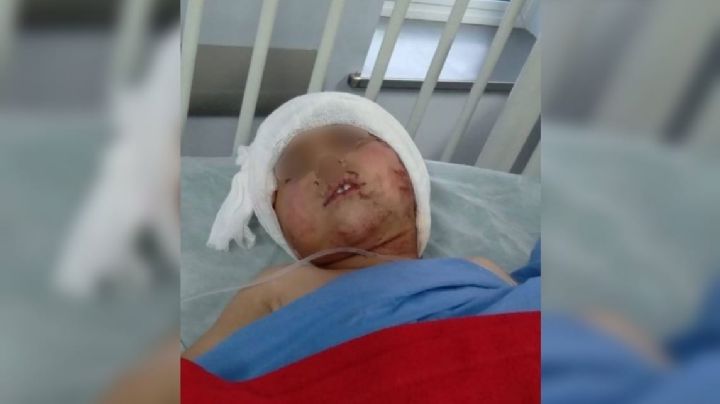 Niño atacado por un pitbull en Caucete: la familia recibió la mejor noticia