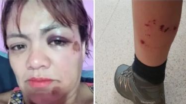 Una jauría atacó ferozmente a una mujer mientras paseaba en bicicleta