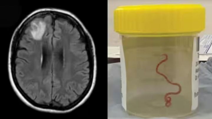 'Vivita y coleando': una lombriz de casi 10 centímetros en el cerebro de una mujer
